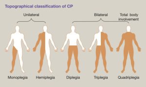 طبقه بندی فلج مغزی بر اساس محل درگیری